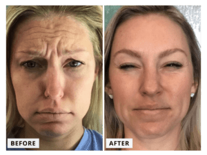 RESTOR Tox Before and After Transformation