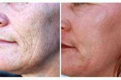 1718915021-laser-skin-resurfacing-6