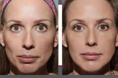 1689370075-sculptra-6