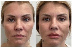 1718909720-sculptra-11