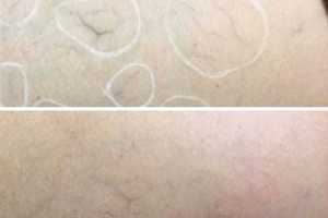 Laser Vein Removal
